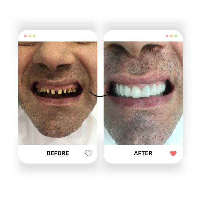 Dental Before & Afters - Hildent - Izmir Turkey Dental Clinic