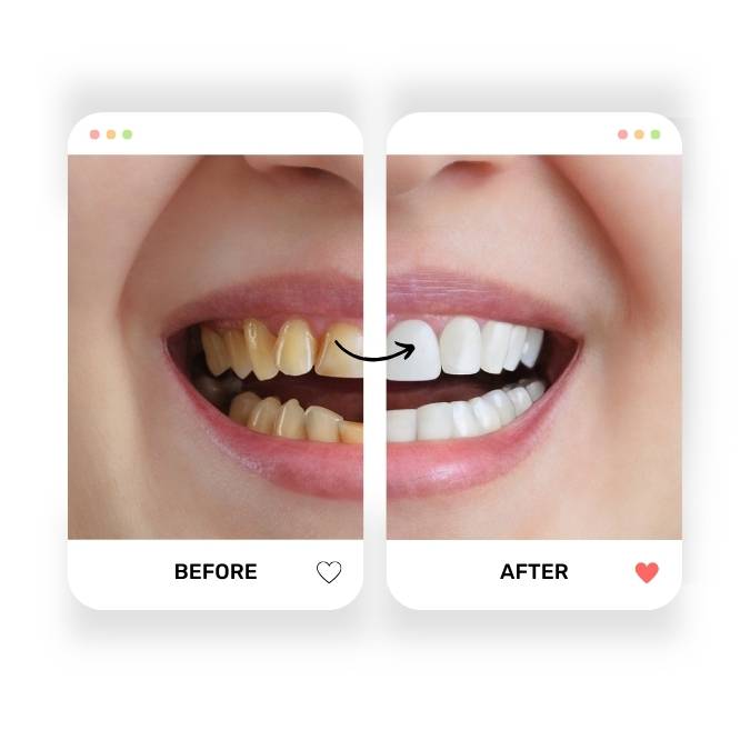 Dental Before & Afters - Hildent - Izmir Turkey Dental Clinic