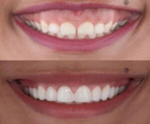 لبخند لثه ای