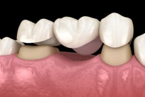 پل دندان بریج دندان